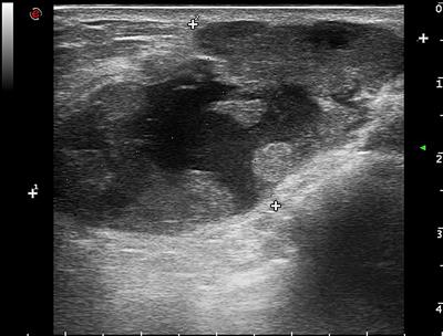 Morphological and molecular pathological features of the breast carcinoma with choriocarcinomatous features: A case report and a literature review